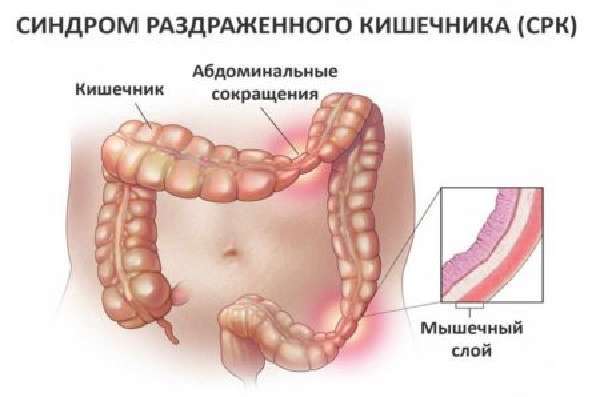 Синдром раздраженного кишечника (срк) – симптомы, причины, лечение, диета