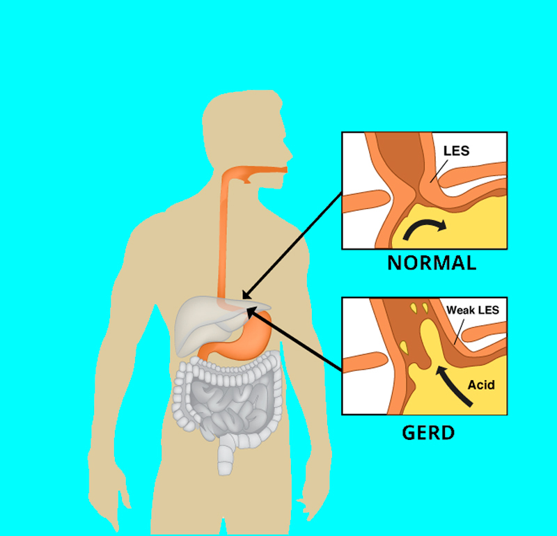 Диета при гэрб: рекомендации о том, что можно есть, меню на каждый день и список продуктов при обострении, его симптомы или лечение
