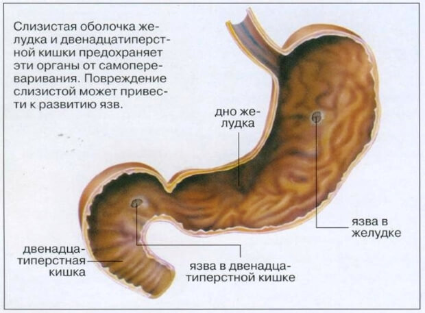 Диета при язве желудка и двенадцатиперстной кишки: стол и рецепты